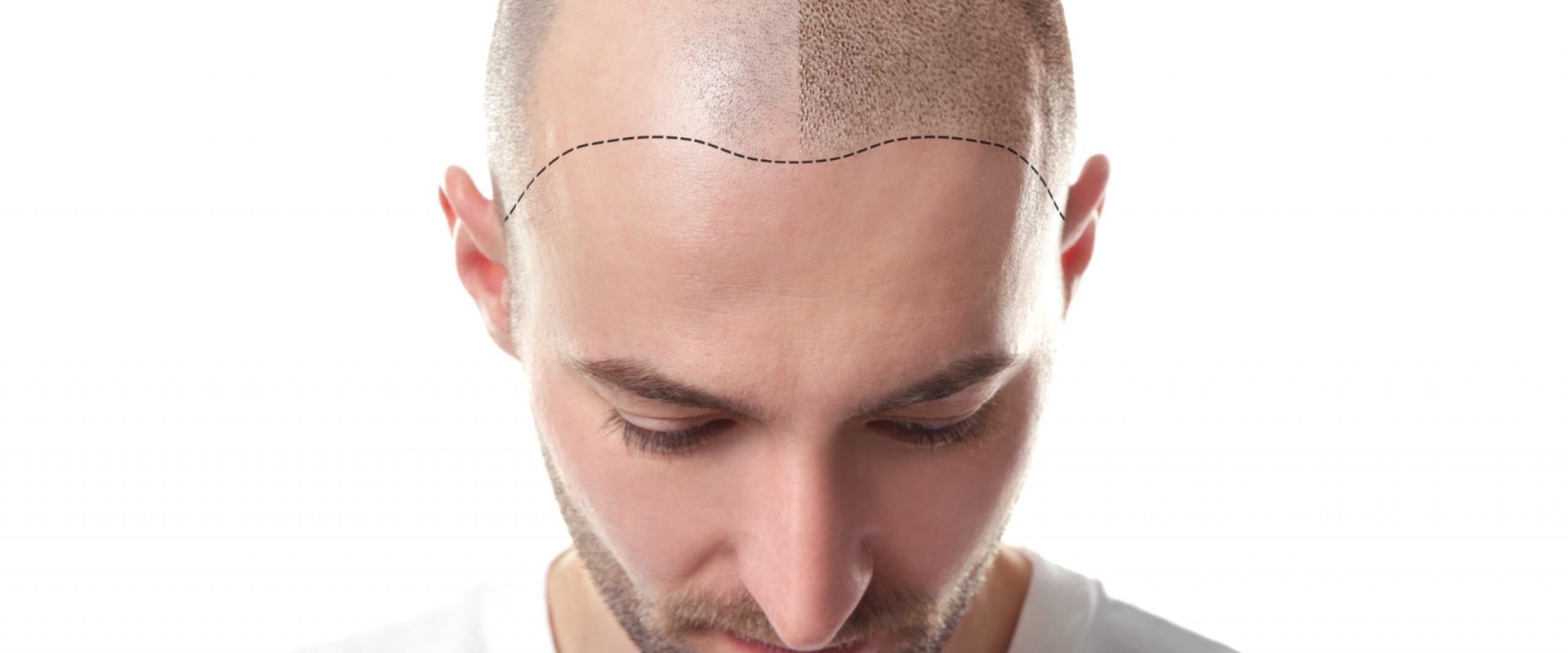 Scalp Camouflage Techniques: What You Need to Know