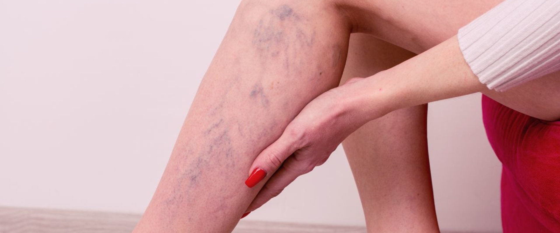 Top 5 Things to Look For in a Spider Vein Treatment Provider