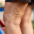 Why Seeing a Vein Doctor Could Help Your Legs Feel Better
