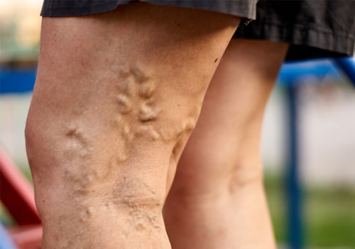 Why Seeing a Vein Doctor Could Help Your Legs Feel Better