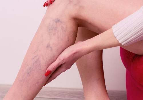 Top 5 Things to Look For in a Spider Vein Treatment Provider